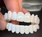 Snap On Teeth Veneers, Removable Snap On Veneers, Clip On Teeth Veneers, Cosmetic Teeth Covers for Smile Makeover